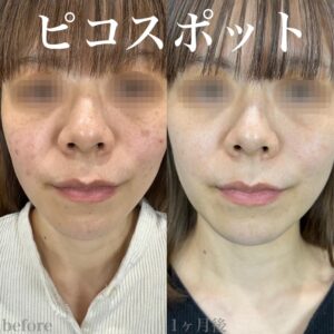 ルラ シミ取り放題 症例