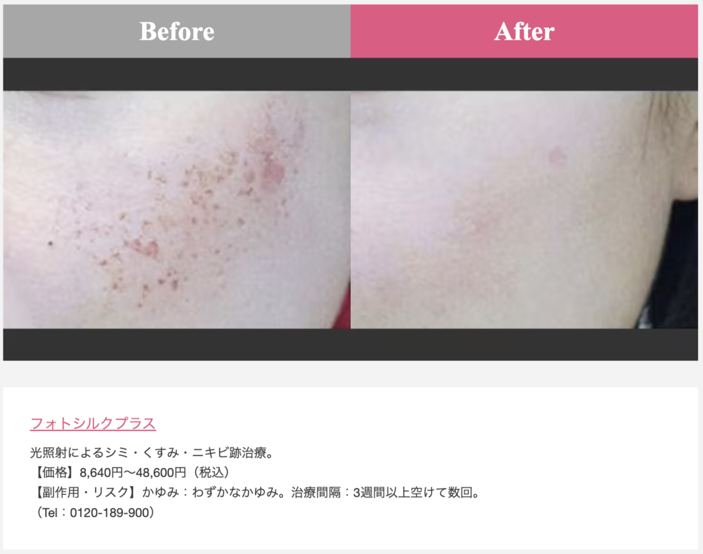 品川美容外科症例写真(シミ)