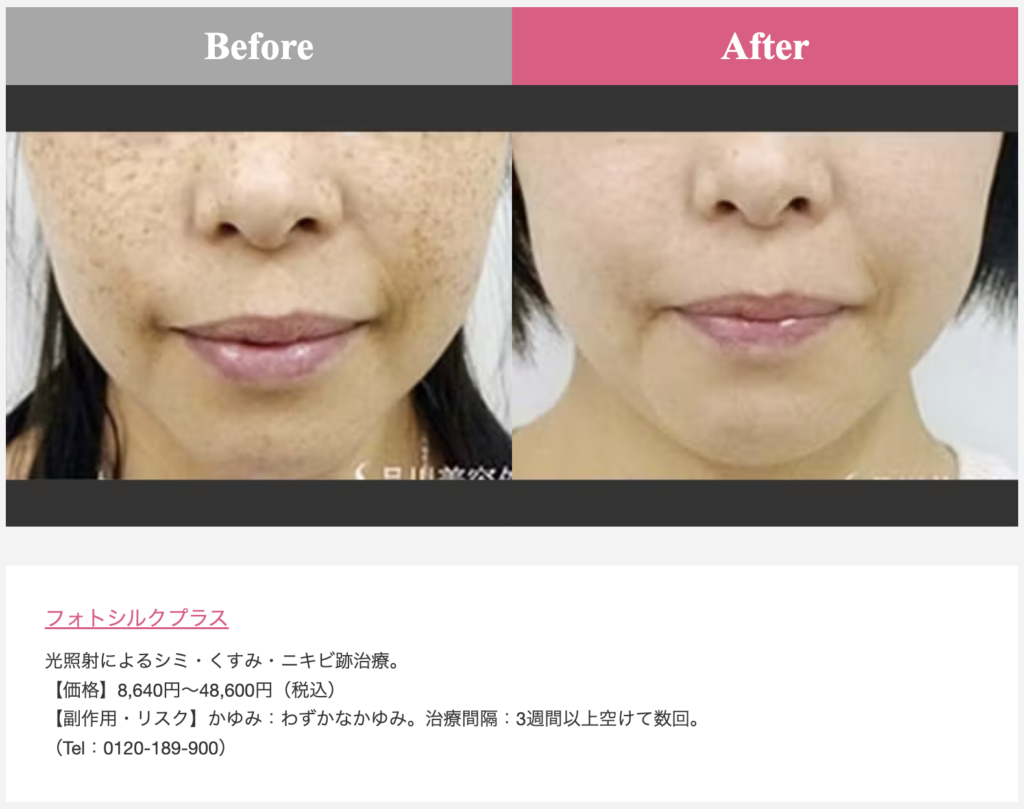 品川美容外科症例写真(そばかす)