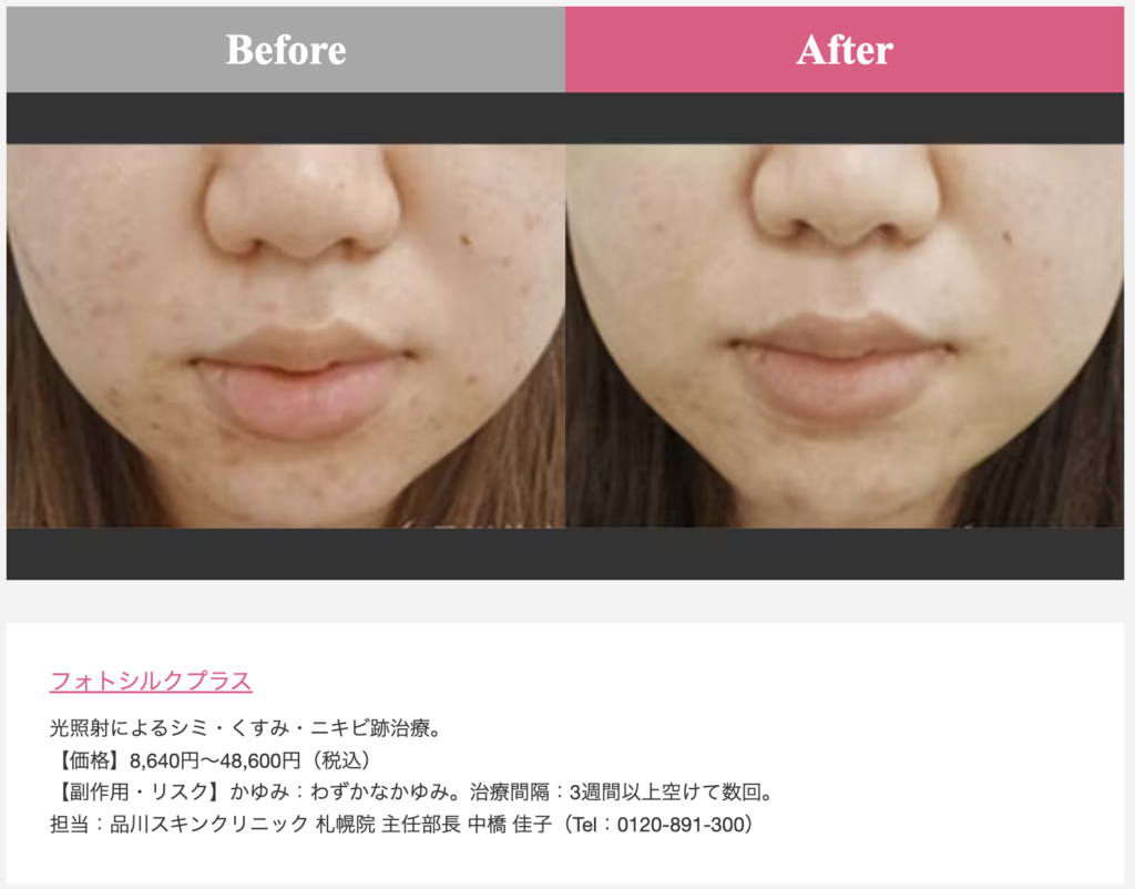 品川美容外科症例写真(ニキビ)